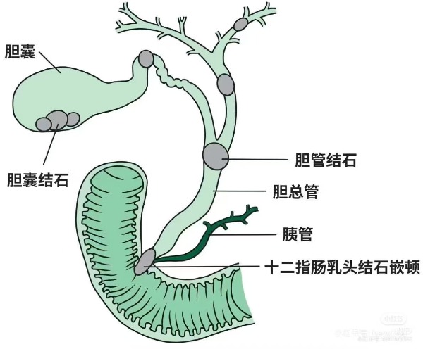 胆总管结石是吃出来的麻烦还是身体的无声警报