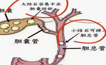 胆总管结石身体里的定时炸弹为何总爱深夜引爆